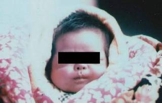 PCB中毒症状ー母親妊娠中に暴露ー黒子出産 PCB中毒症状ー母親妊娠中に暴露ー黒子出産
