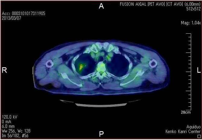 PET/CT摜