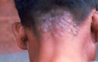 PCB中毒症状ー後頭頚部アクネー